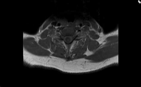 Syringomyelia MRI | Radiology article on syrinx