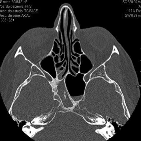 Pdf Differential Diagnosis And Treatment Of Isolated Pathologies Of The Sphenoid Sinus