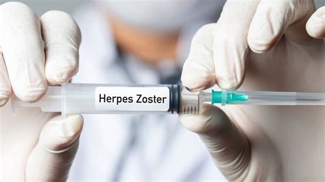 Prirodni lijekovi za herpes zoster koji će umanjiti bol