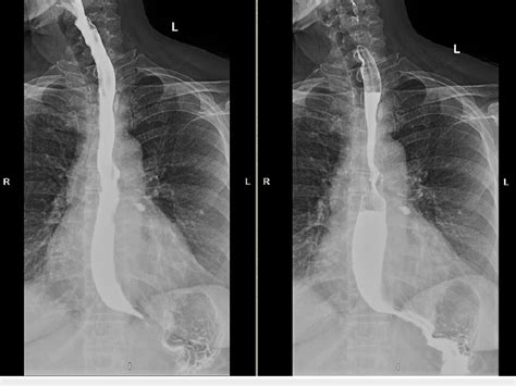 Barium Swallow Demonstrating Narrowing At The Gastroesophageal Junction