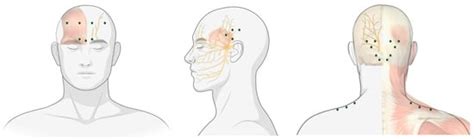 Jcm Free Full Text Onabotulinumtoxina In Migraine A Review Of The Literature And Factors