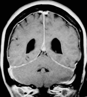 Cerebrospinal Fluid Leak Imaging Practice Essentials Computed