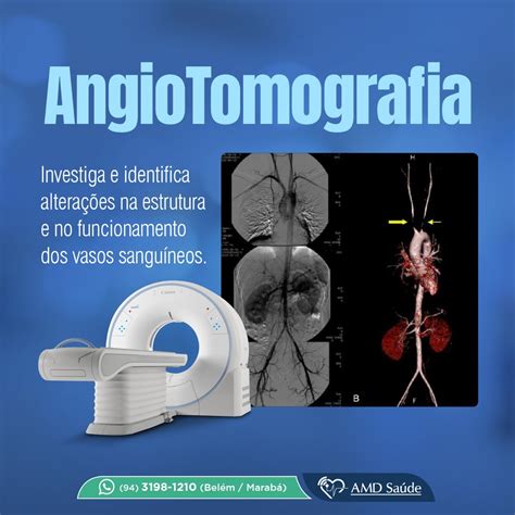 Angiotomografia O Que É - Angiotomografia: O que é, como funciona e o preparo • AMD Saúde