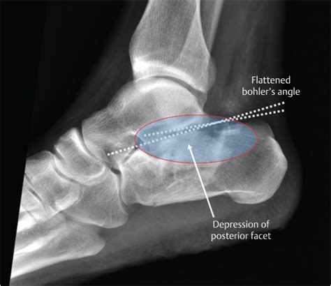 45 Calcaneus Fractures Musculoskeletal Key