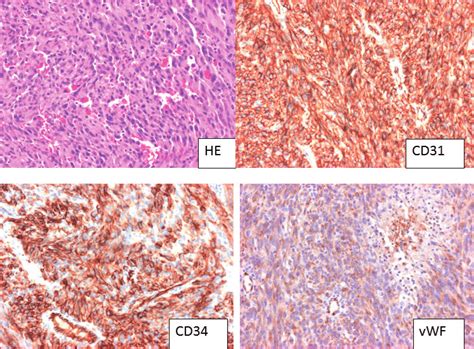 Hematoxylin And Eosin Staining Revealed Extensive Invasion Of Aberrant