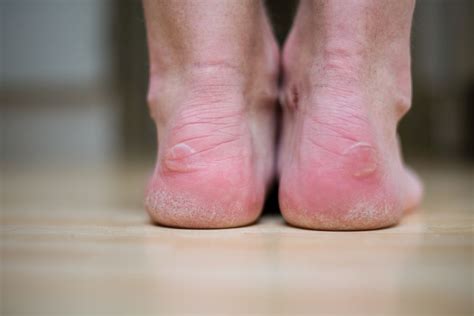 Seven Types Of Blisters That Will Haunt You If You Keep Running Hard