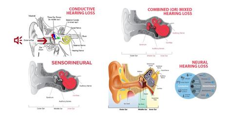 Types of Hearing Loss - Mixed Hearing Loss - Neural Hearing Loss