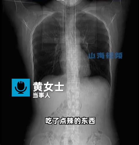 瘦弱女子吃辣被呛 咳断4根肋骨 国际 東方網 馬來西亞東方日報