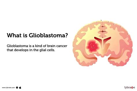 Glioblastoma Causes Symptoms Treatment And Cost