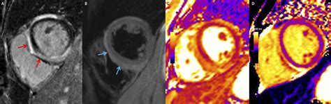 Cardiac Imaging In Myocarditis Current Evidence And Future Directions