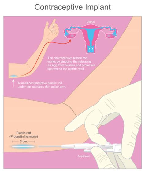 Contraceptive Patch How It Works