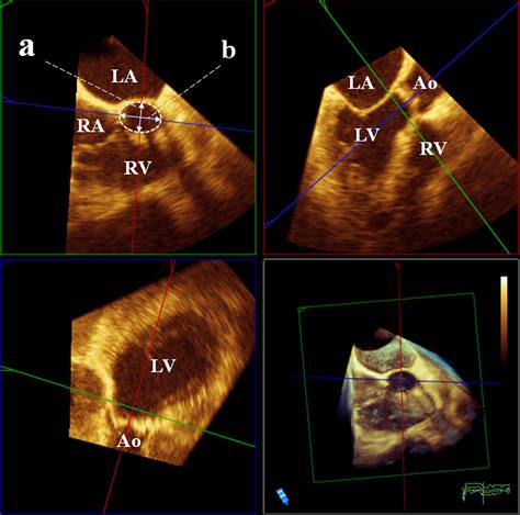 Comparison Of Left Ventricular Outflow Geometry And Aortic Valve Area