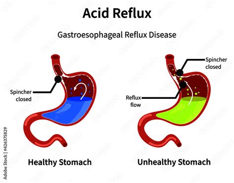 Acid Reflux Or Gastroesophageal Reflux Heartburn Gastric Disease