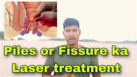 Piles And Fissure Laser Treatment Without Surgery Bawaseer Ka Jad Se