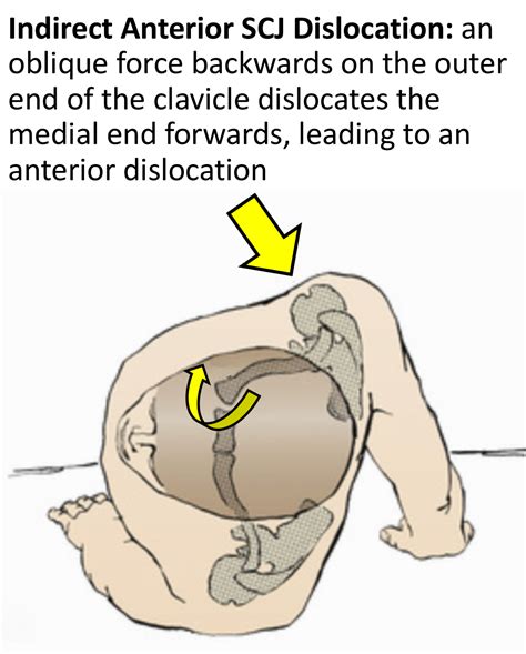 Anterior Dislocations Cambridge Shoulder