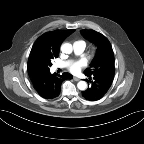 Rectal Cancer T1 Image