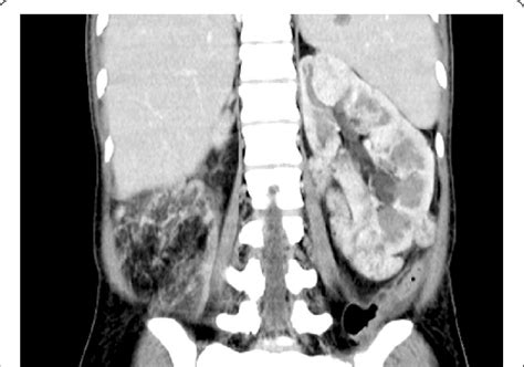 Huge Right Sided Renal Angiomyolipoma With A Bleeding Pseudoanurysm