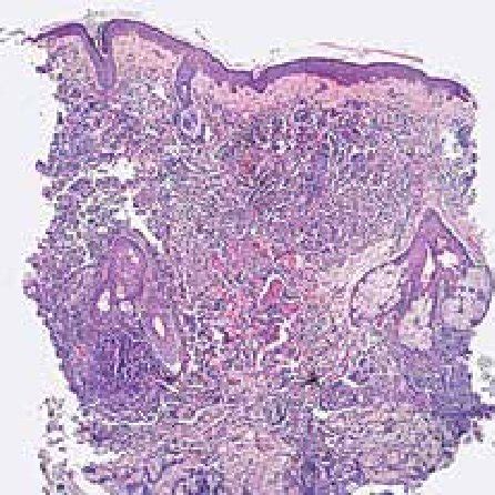 A Erythematous Violaceous Plaque B Full Remission Of The Lesion After