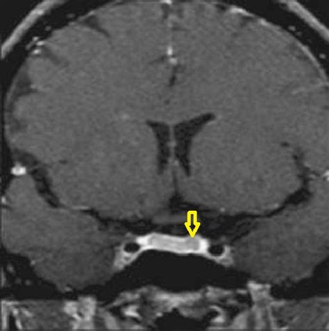 Dr Balaji Anvekar FRCR: Pituitary Microadenoma MRI