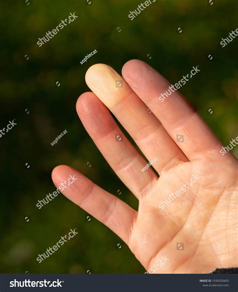 Fingers Raynauds Syndrome Raynauds Diseases Female Stock Photo