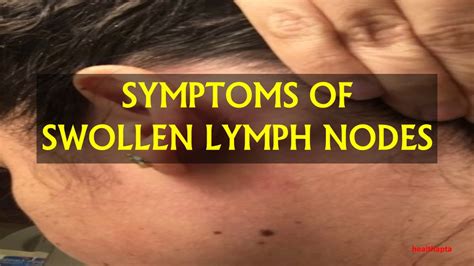 Rash And Swollen Lymph Nodes Causes Photos And Treatment