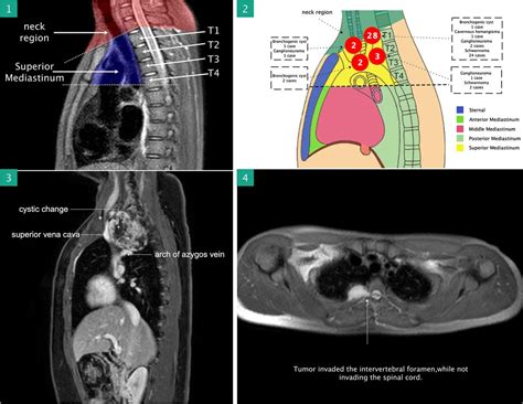 Frontiers Initial Experience With Robotic Assisted Thoracic Surgery