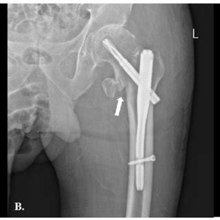 A The Preoperative Anteroposterior Ap Radiograph Showing An