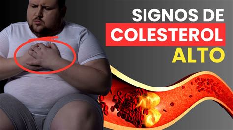 9 Signos De Colesterol Alto Que No Debes Ignorar Si Tienes Más De 50