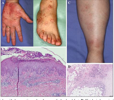 Figure 1 from TNF α inhibitor induced paradoxical psoriasis and