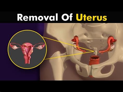 What Happens In Hysterectomy Uterus Removal Surgery Animation YouTube