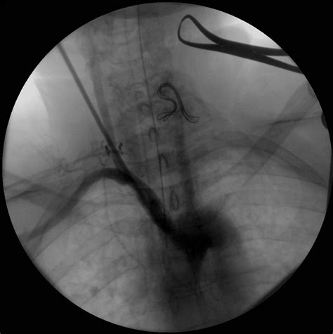 Simultaneous Transcervical Angioplasty And Stenting Of Innominate And