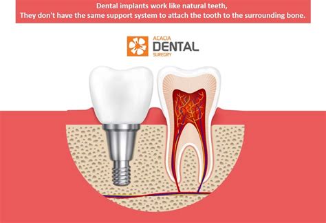 What Is Peri Implantitis And How To Treat It Acacia Dental