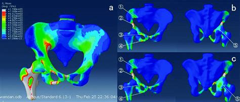 A Stress Distribution Of Normal Pelvis In Affected One Legged Jumping Download Scientific