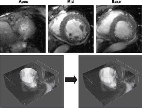 Figure From Improved Quantification Of Left Ventricular Volumes And