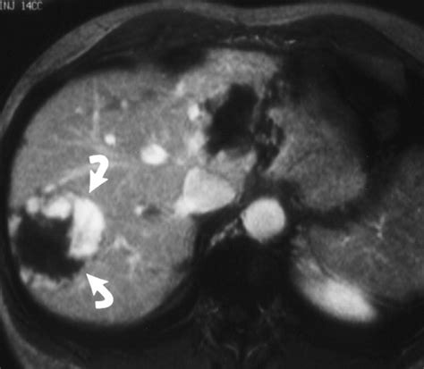 Ct And Mr Imaging Of Benign Hepatic And Biliary Tumors Radiographics