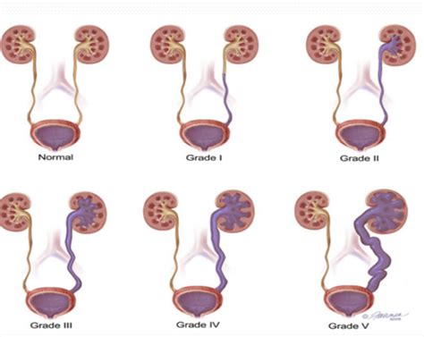 Peds Gu Renal Flashcards Quizlet