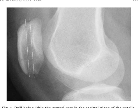 Figure 1 From Double Fixation Of Displaced Patella Fractures Using