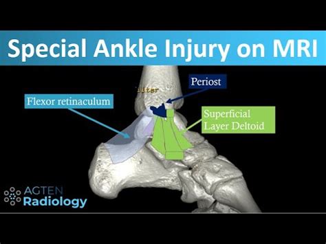 Deltoid Ligament Tear On MRI YouTube