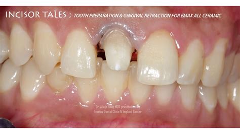 Dental Treatment For Fractured Front Tooth With Emax All Ceramic Crown