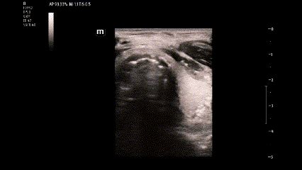 Visualizing an ETT on Ultrasound — Kwak Talk