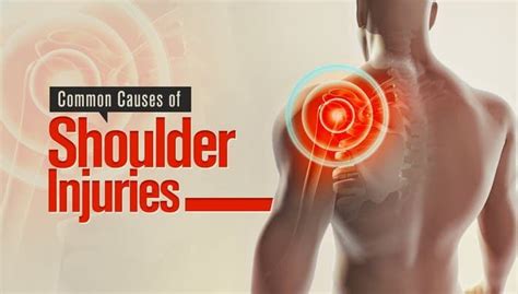 Common Causes Of Shoulder Injuries San Diego Orthobiologics Medical Group