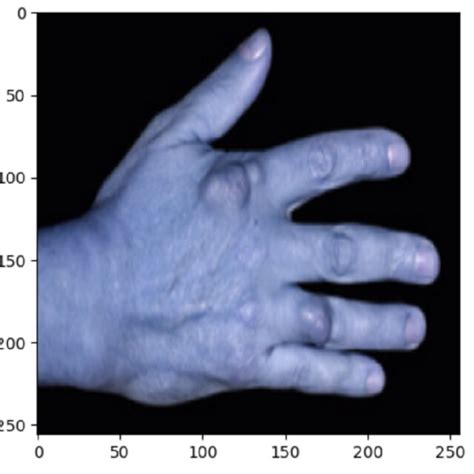 Preprocessed image of arthritic hands in the model. An image from the ...