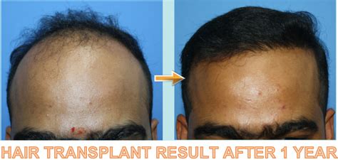 Success Rate Of Hair Transplant In India