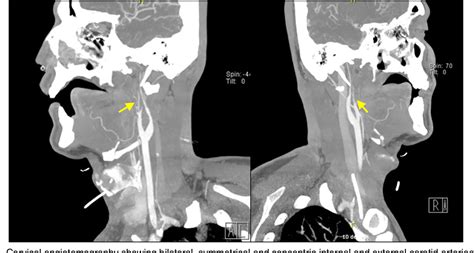 Figure 1 From Leukocytoclastic Vasculitis In A Patient With Syphilis