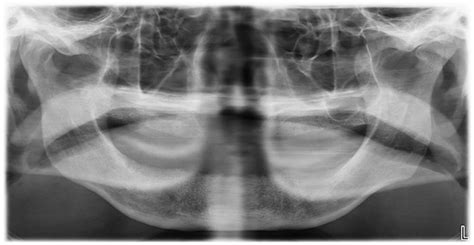 Aggressive Nasopalatine Cyst With Nasal Involvement In An Edentulous