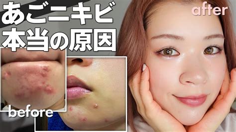 あごニキビの原因と治し方！マスクを外してもニキビゼロになりたい女の徹底分析 Youtube