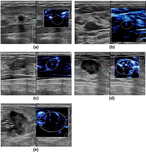 Value Of Micro Flow Imaging And High Definition Micro Flow Imaging In