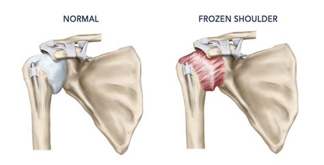 Frozen Shoulder Hartwell Physiotherapy