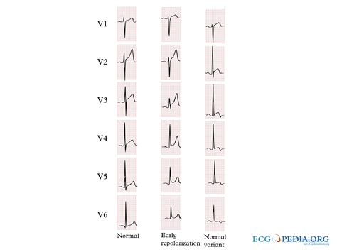 File Normal St Elevation Svg Ecgpedia