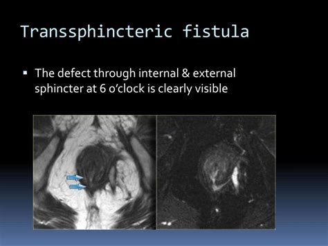 Ppt Mri Imaging Of Perianal Fistula Powerpoint Presentation Free